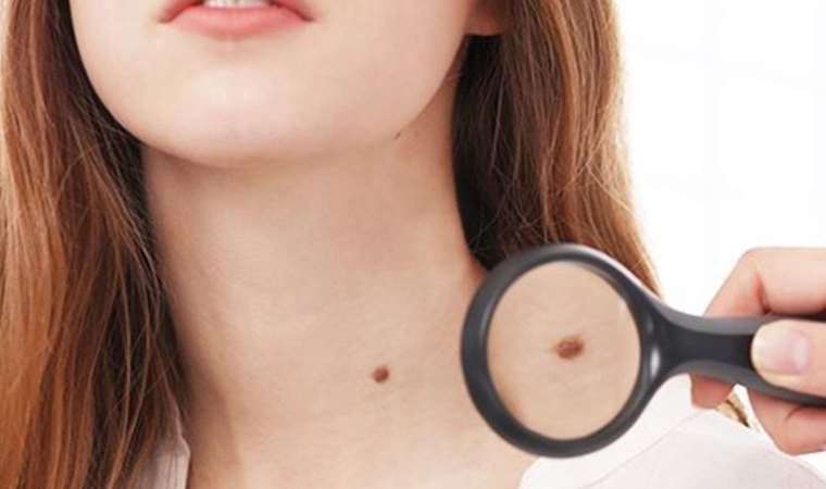 Aksesuarlarınız et beni oluşumunu tetikleyebilir