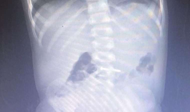 Çivi yuttu, hastanelik oldu