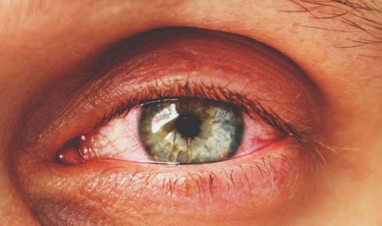 ‘Kırmızı göz’ salgını yayıldı: 86 bin kişi şikayetçi