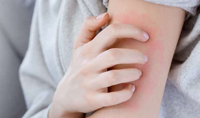 Uzmanlar: Uyuz vakaları kaygı verici boyutta