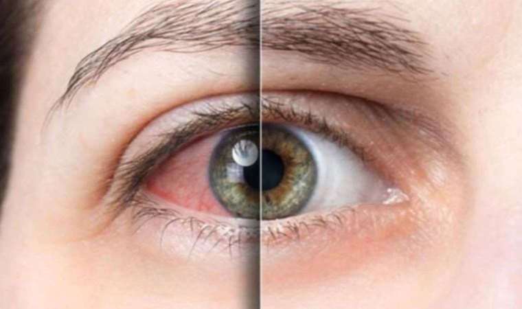 Sonbaharda göz hastalıklarına dikkat!