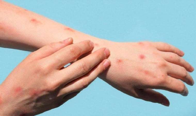 Yunanistan’da Batı Nil Virüsü nedeniyle 19 kişi öldü