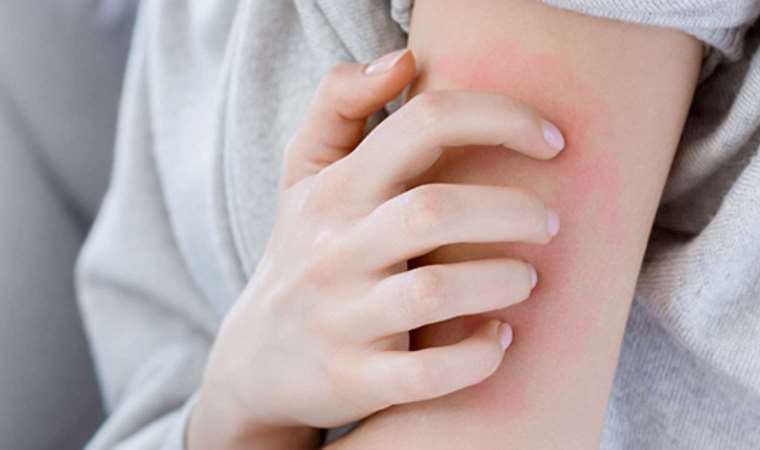 Uyuz vakaları yüze 40 oranında arttı: Uyuzdan nasıl korunulur?