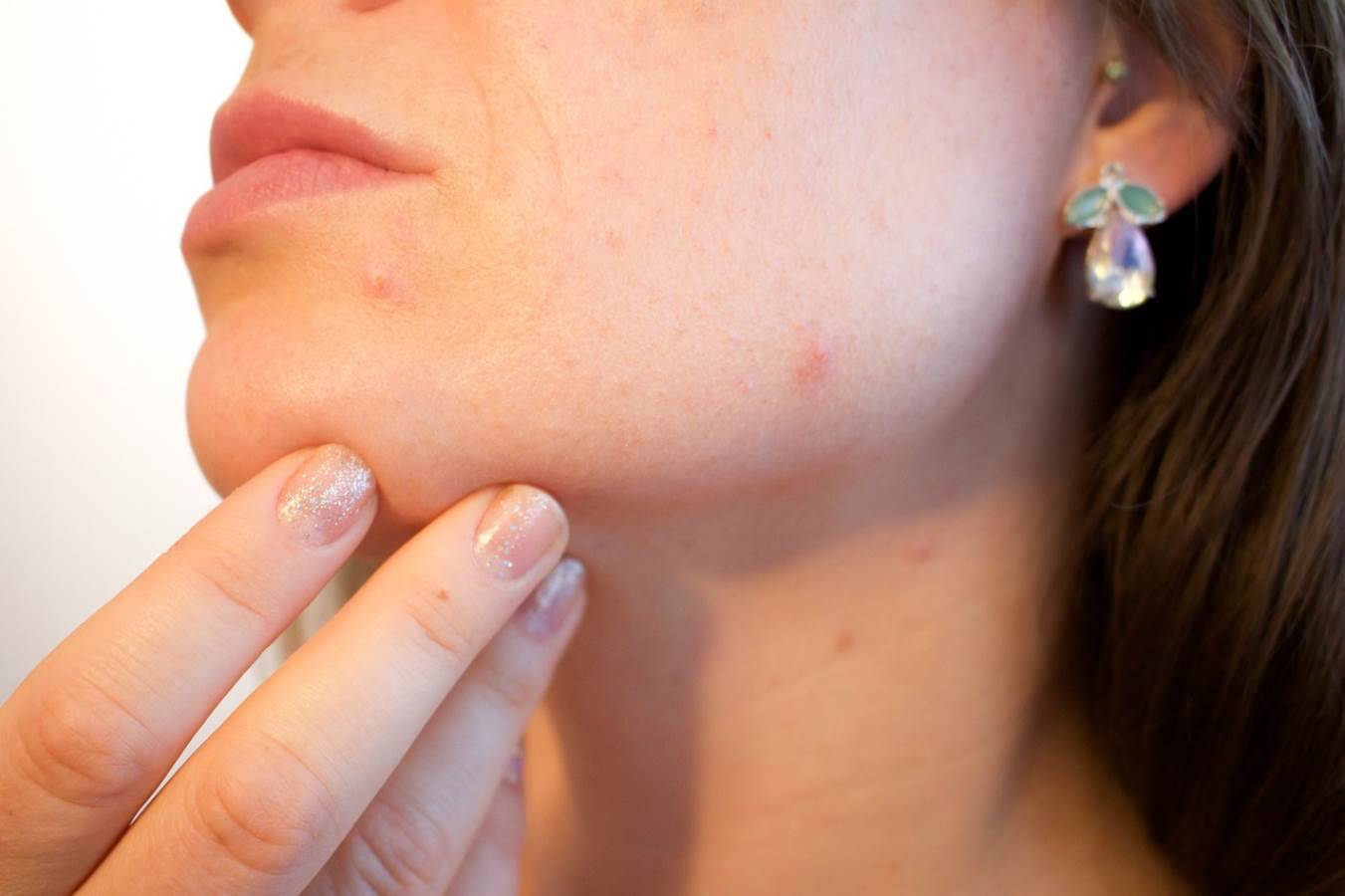 Dermatologlar anlattı: Sivilcelerinizden nasıl kurtulursunuz?