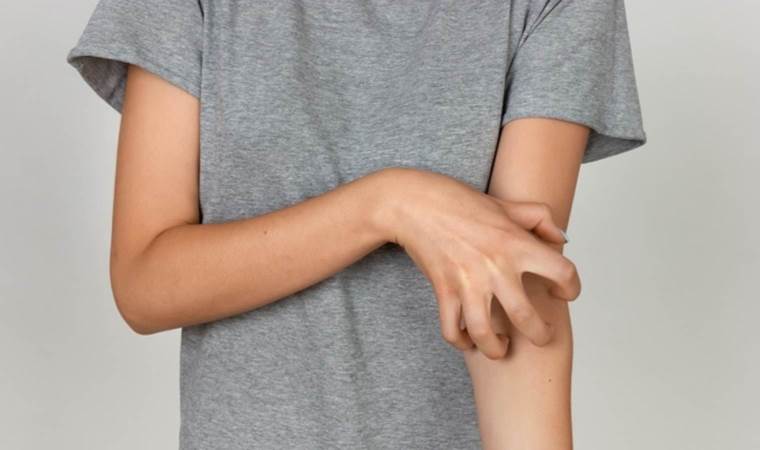 Uzmanı uyardı: ‘Uyuz tedavisinde ilaçlar yetersiz kalıyor’