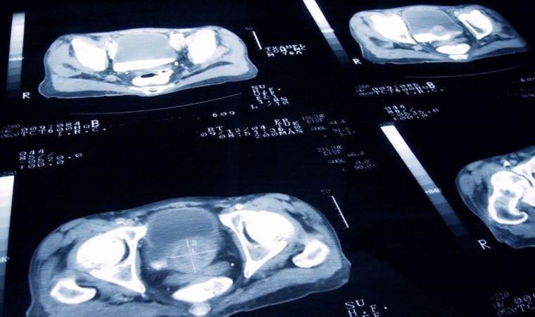 Kadınlarda ve erkeklerde en fazla görülen kanser türleri belli oldu