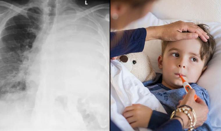 Avrupa’da ‘Beyaz Akciğer Sendromu’ vakalarında artış