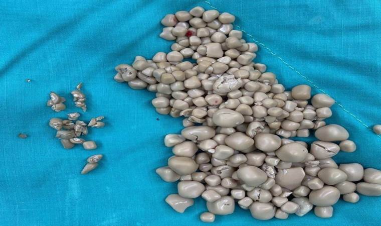 20 yaşındaki kızın böbreklerinden çıkanlar şaşırttı