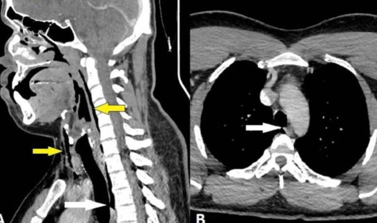 Bilim tarihinde bir ilk: Hapşırığını tutunca nefes borusu yırtıldı