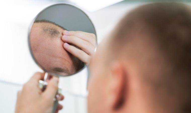 Uzmanlar uyardı: Saç dökülmesini etkileyerek kelliğe neden olabilir…