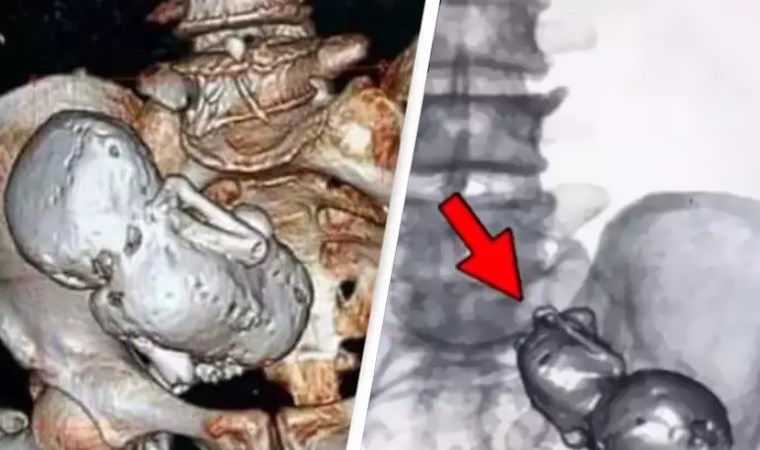 73 yaşındaki kadının rahminde ‘taş bebek’ bulundu