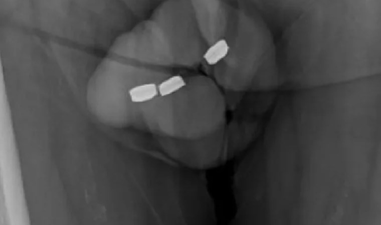 73 yaşındaki adam, mastürbasyon yaparken hastanelik oldu