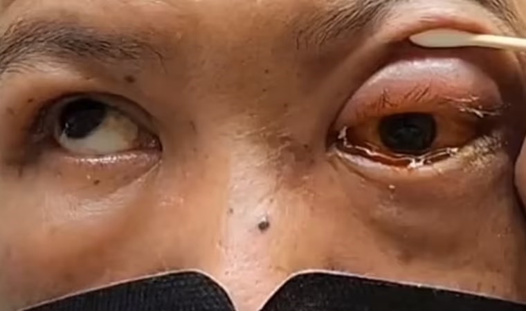 Sarhoşken yüzüstü uyudu: Kör oldu