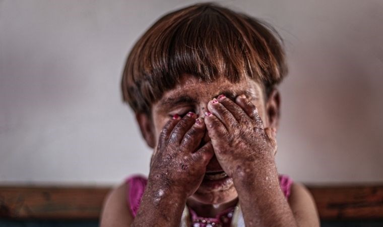 Pemfigus hastalığı nedir? Pemfigus hastalığının belirtileri nelerdir?