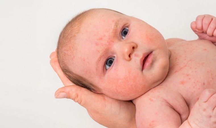 Bebeklik döneminde egzamaya dikkat! İşte bebeklerde egzama belirtileri…