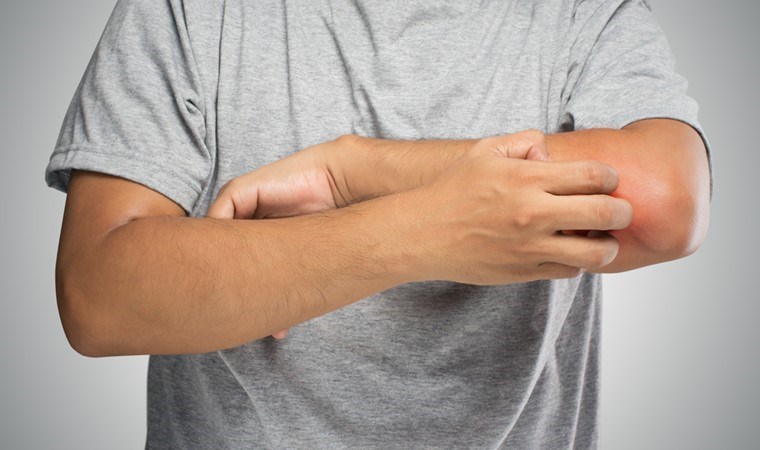 Ter, gözyaşı ve tükürük bile neden olabiliyor!  Kış aylarında ciltte görülüyor…