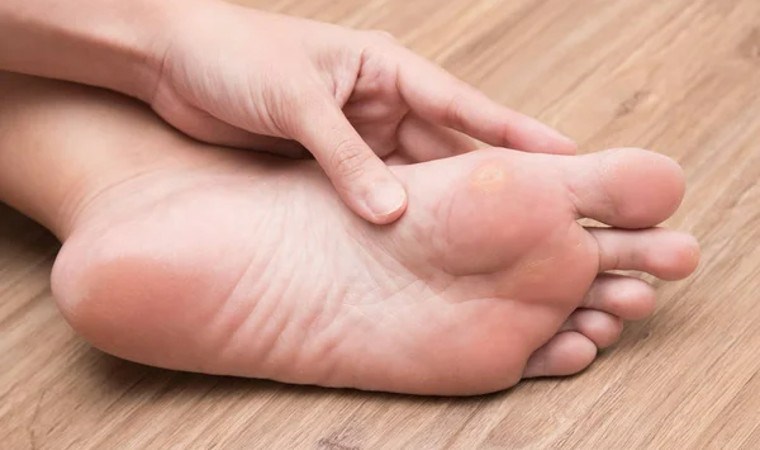Nasırlarınızdan kökten kurtulun! Nasıra iyi gelen 5 doğal çözüm…