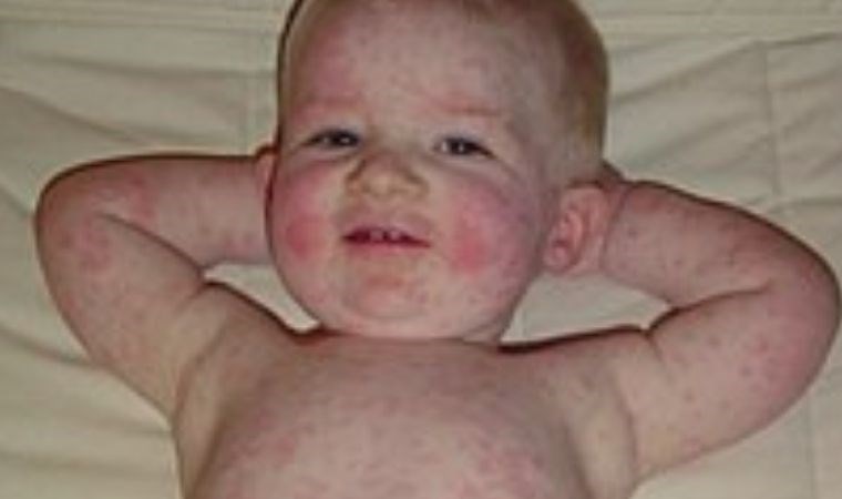 Beşinci hastalık nedir? Beşinci hastalık belirtileri neler? Beşinci hastalık bulaşma yolları…