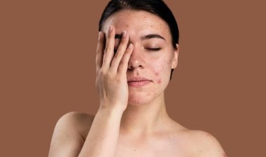 Akneler için 5 doğal yöntem: Sivilcelerinize veda edin… – Son Dakika Yaşam Haberleri | Cumhuriyet