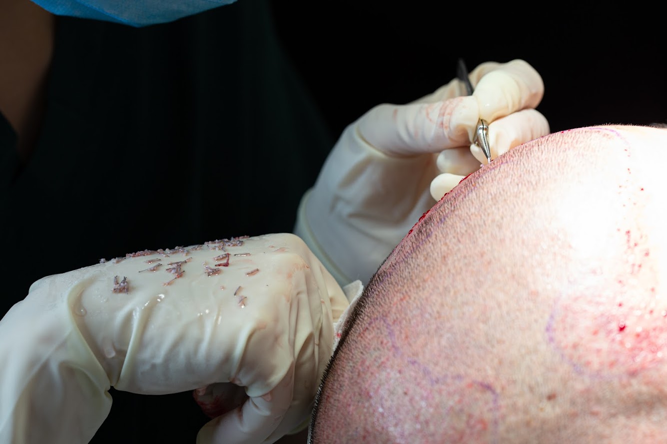 DHI Saç Ekimi ile Clinista Saç Ekim Merkezi’nde Doğal Sonuçlar