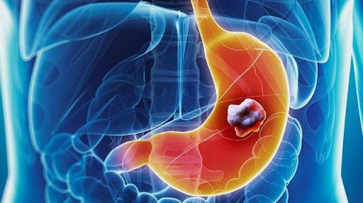 Mide Kanseri Tedavisinde Yeni Umut