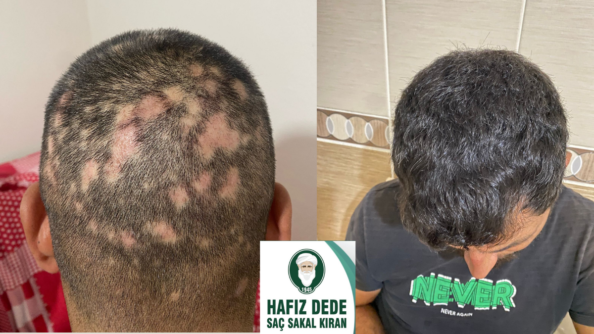 Hafız Dede Saç Kıran Tedavisi: Geleneksel Bilgi ile Doğal Yaklaşımın Bilimsel Perspektifi