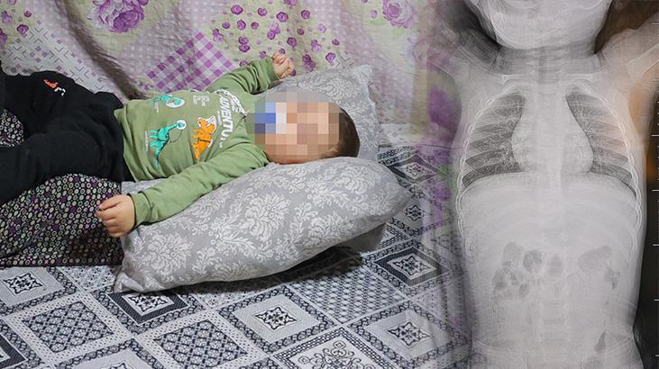 Kuvözde Kaldığı Hastanede Bebeğin Belinde Zımba Teli Unutuldu İddiası: Aile Suç Duyurusunda Bulundu