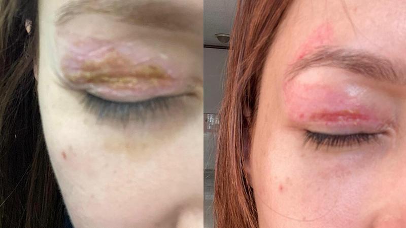 Güzellik Salonunda Yapılan Plazma Pen İşlemi Yargıya Taşındı: Kalıcı Hasar İddiası Reddedildi