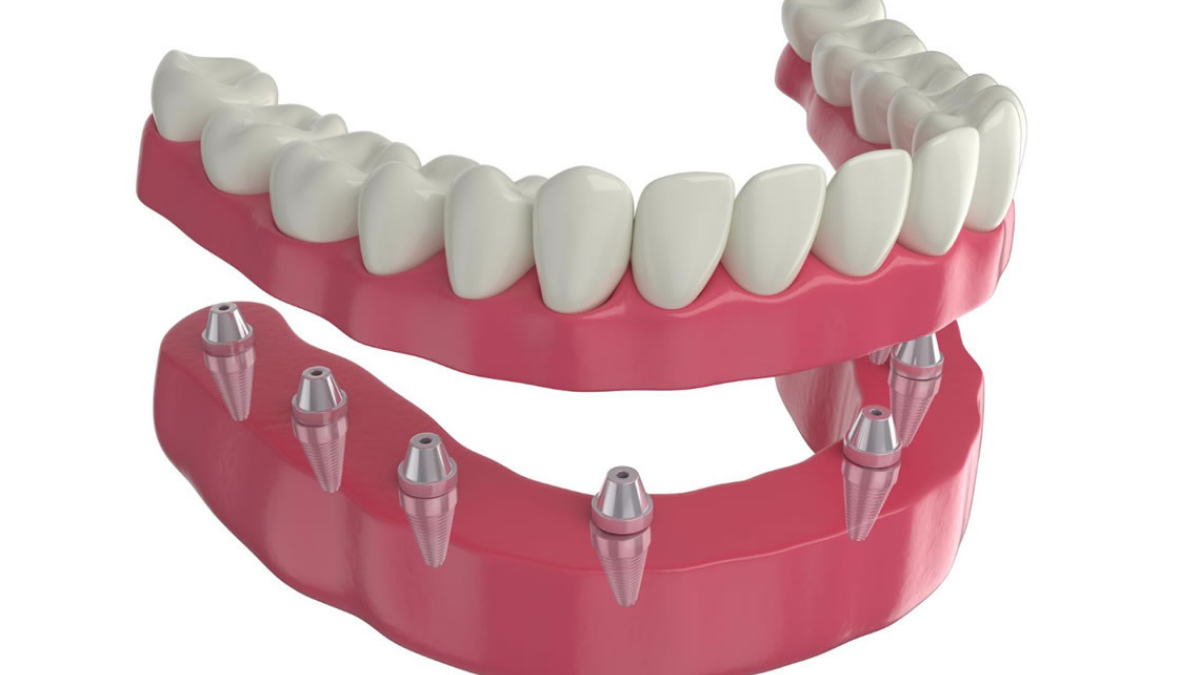Apexcore İmplant ile Eksik Diş Sorununa Alman Çözümü: Doğal, Konforlu ve Dayanıklı